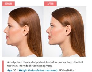Kybella before & after