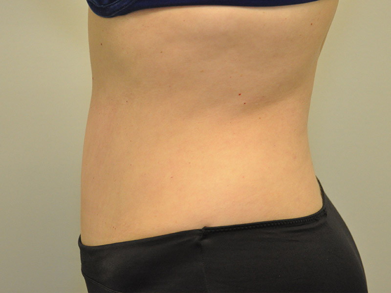 Tummy Tuck Before and After | Steven Ringler MD - Center for Aesthetics And Plastic Surgery