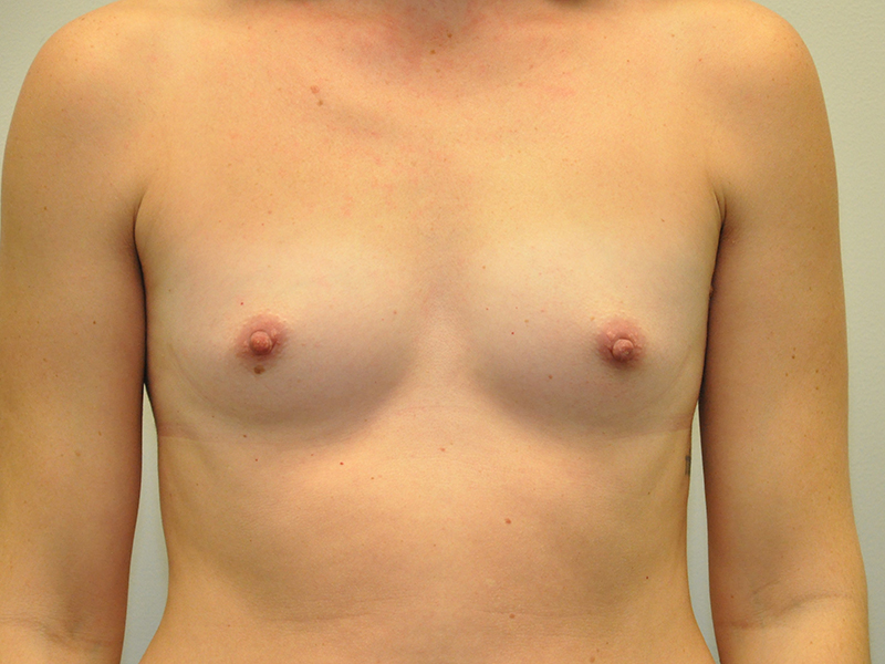 Breast Augmentation in Grand Rapids after 2
