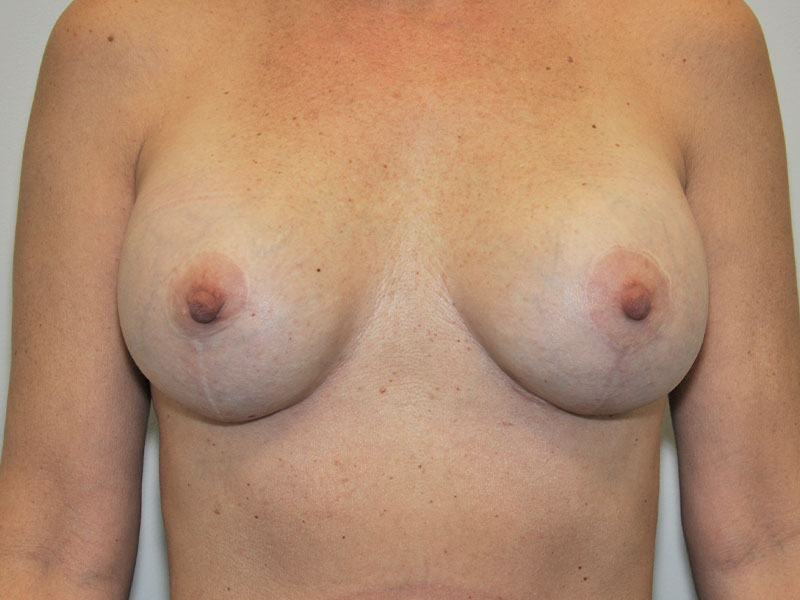 Breast Lift Before and After | Steven Ringler MD - Center for Aesthetics And Plastic Surgery